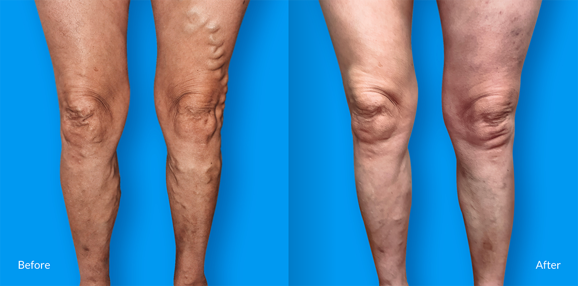 Legs operation before and after