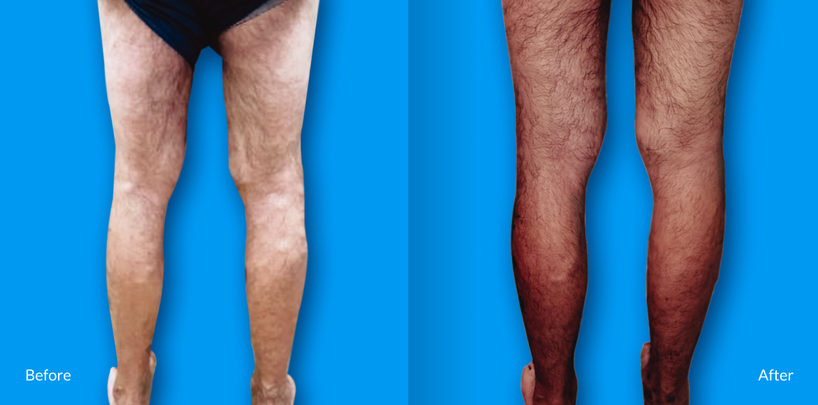 before and after Legs operation for Man